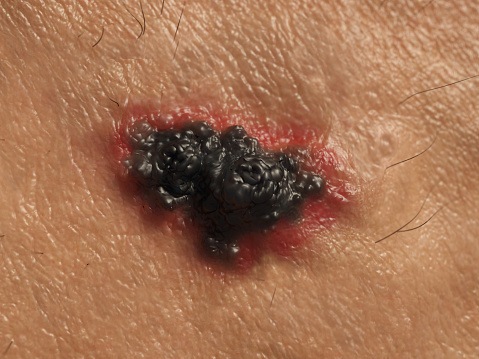 Wearable patch may provide new treatment option for skin cancer​